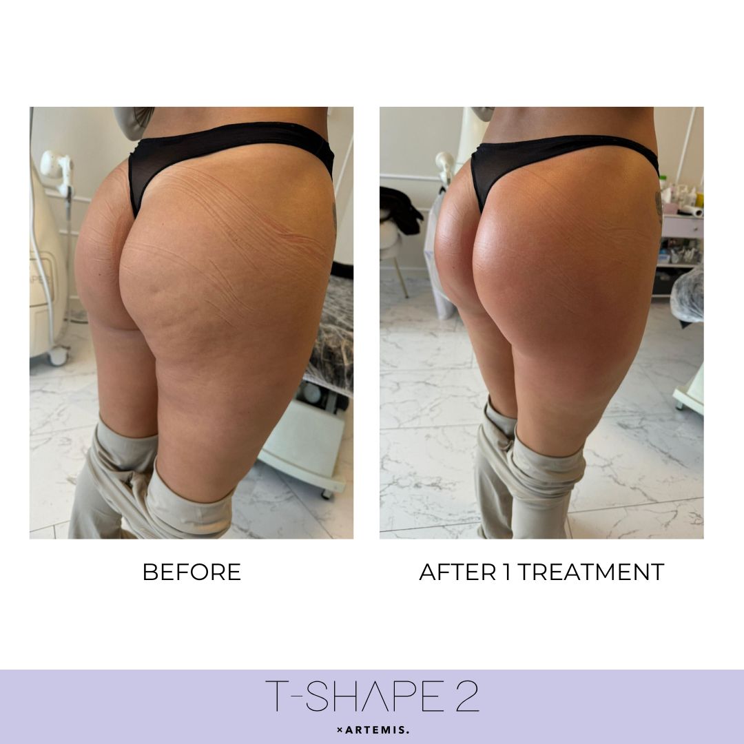 T-Shape 2 before and after results — Body