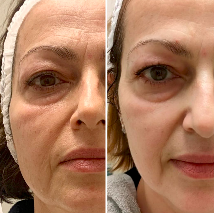 T-Shape 2 Facial before and after results — Eye & Cheek Area