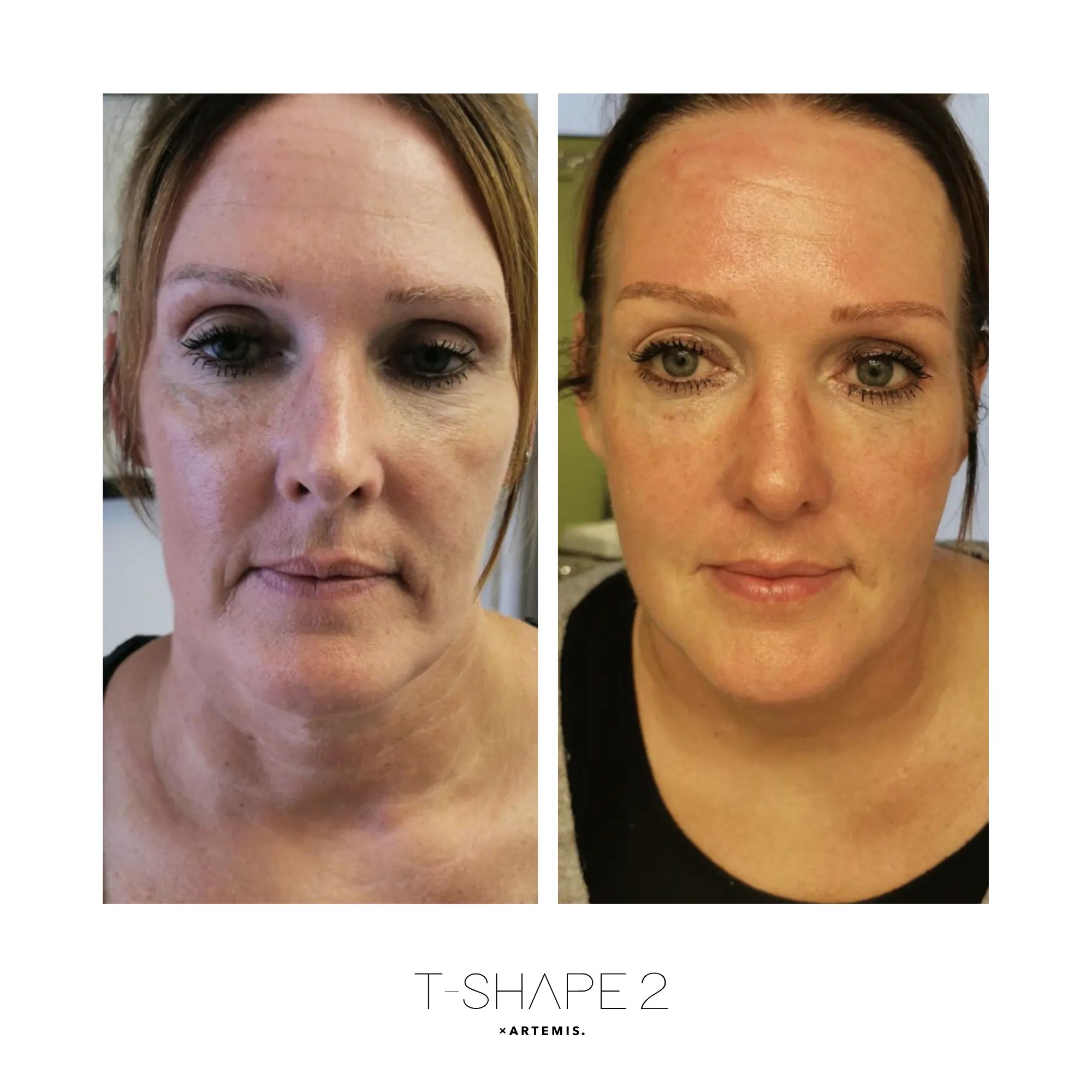 T-Shape 2 before and after results — Face