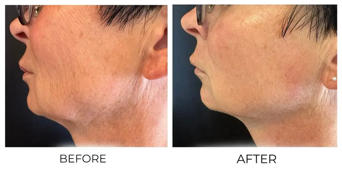 T-Shape 2 Facial before and after results — Face & Neck