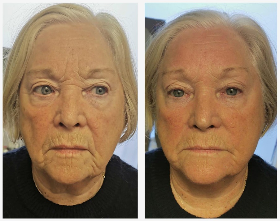 T-Shape 2 Facial before and after results — Full Face