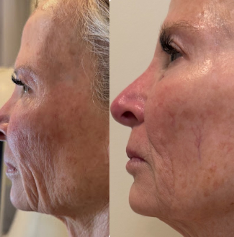 T-Shape 2 Facial before and after results — Face & Jawline
